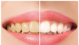 Dişlerin Renginin Değişmesinin Nedenleri ve Diş Rengini Beyazlatma Teknikleri
