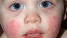 Ailede yer alan alerjik reaksiyonlar çocukların mirası olabilir